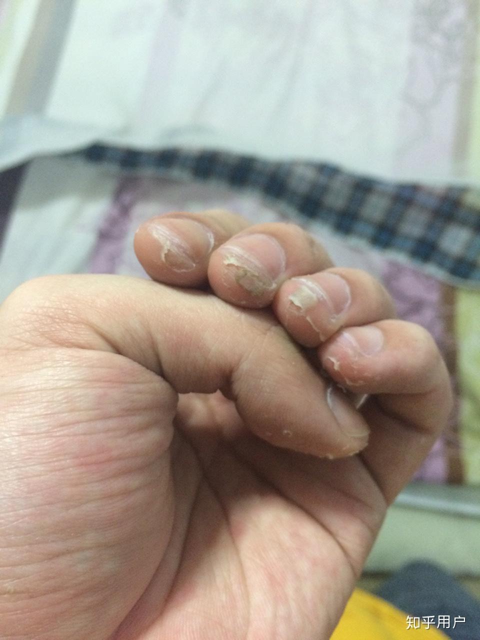 大家弹吉他的手指都是什么样的? - 知乎