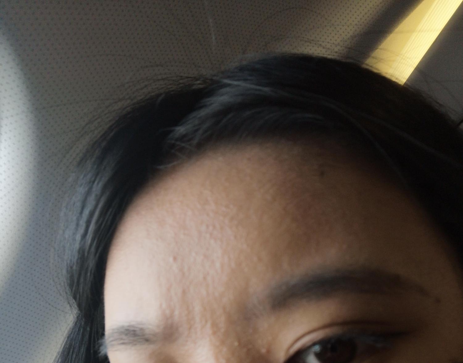 额头长了好多小疙瘩,这是粉刺还是痘痘还是脂溢性皮炎? - 知乎