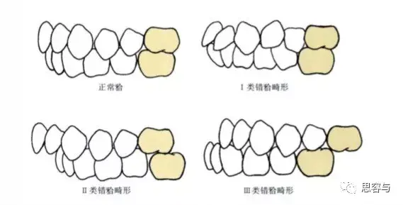 牙齿远中关系示意图图片