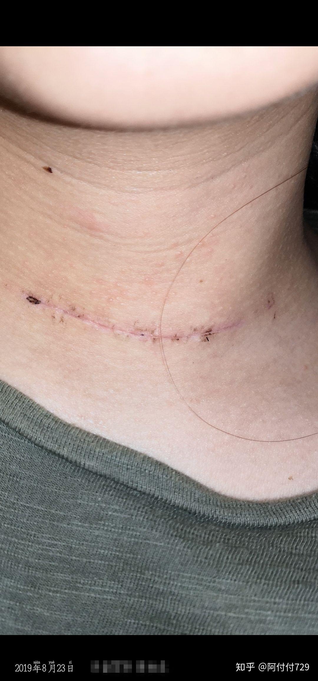 甲状腺术后病理结果刀口恢复情况