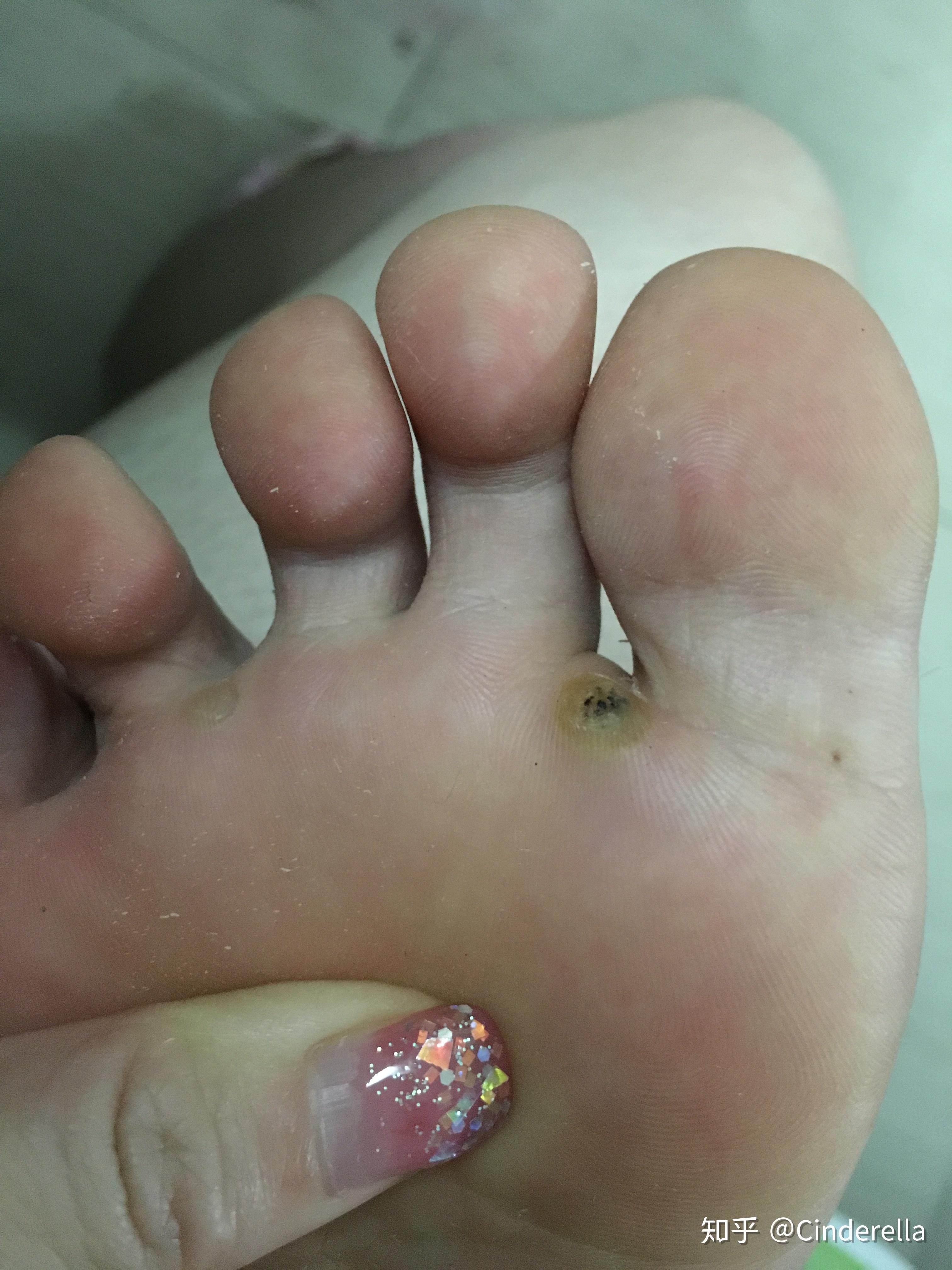 跖疣冷冻 跖疣敷大蒜亲测痊愈