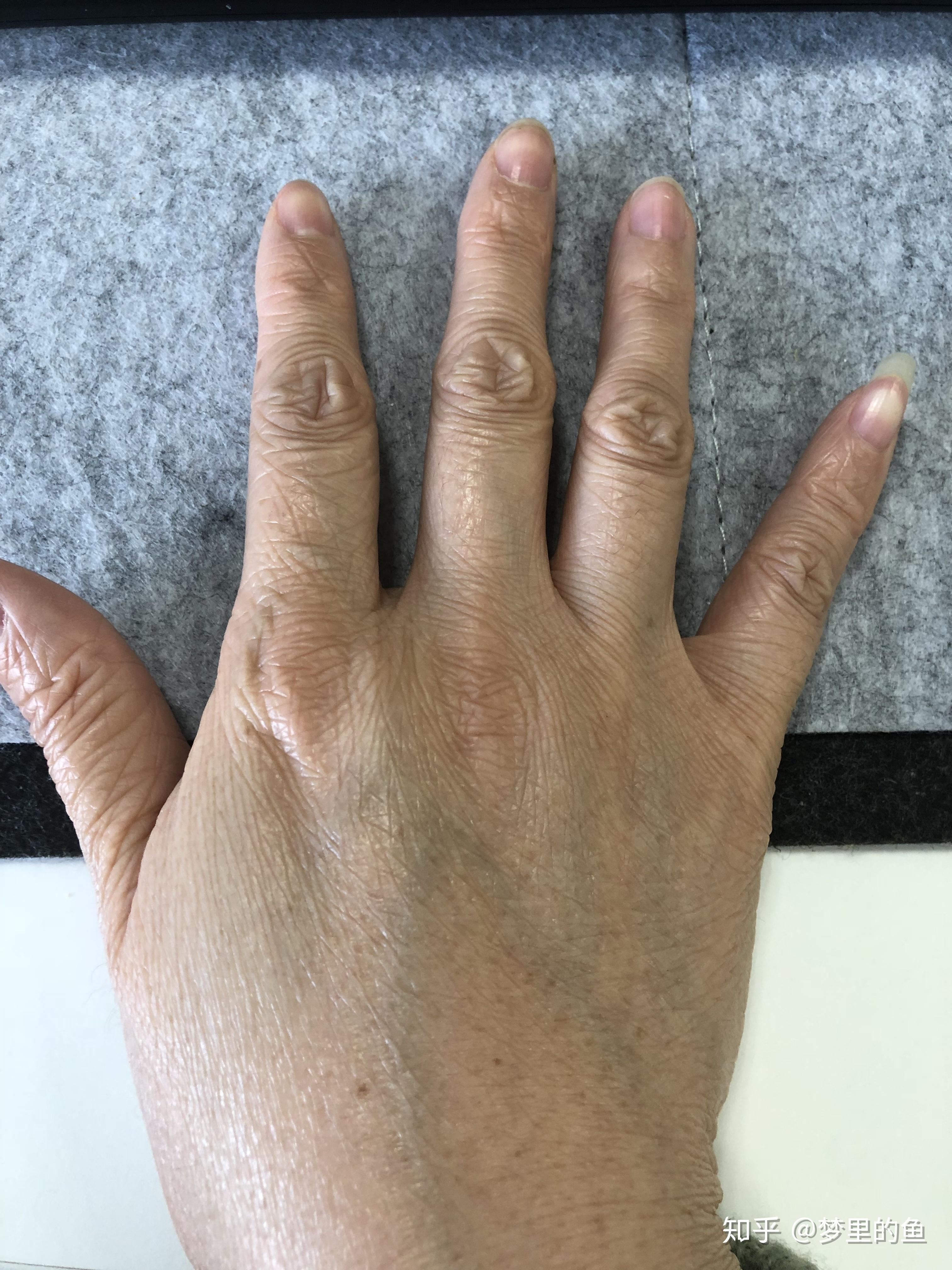 记录鱼鳞病的岁月2018