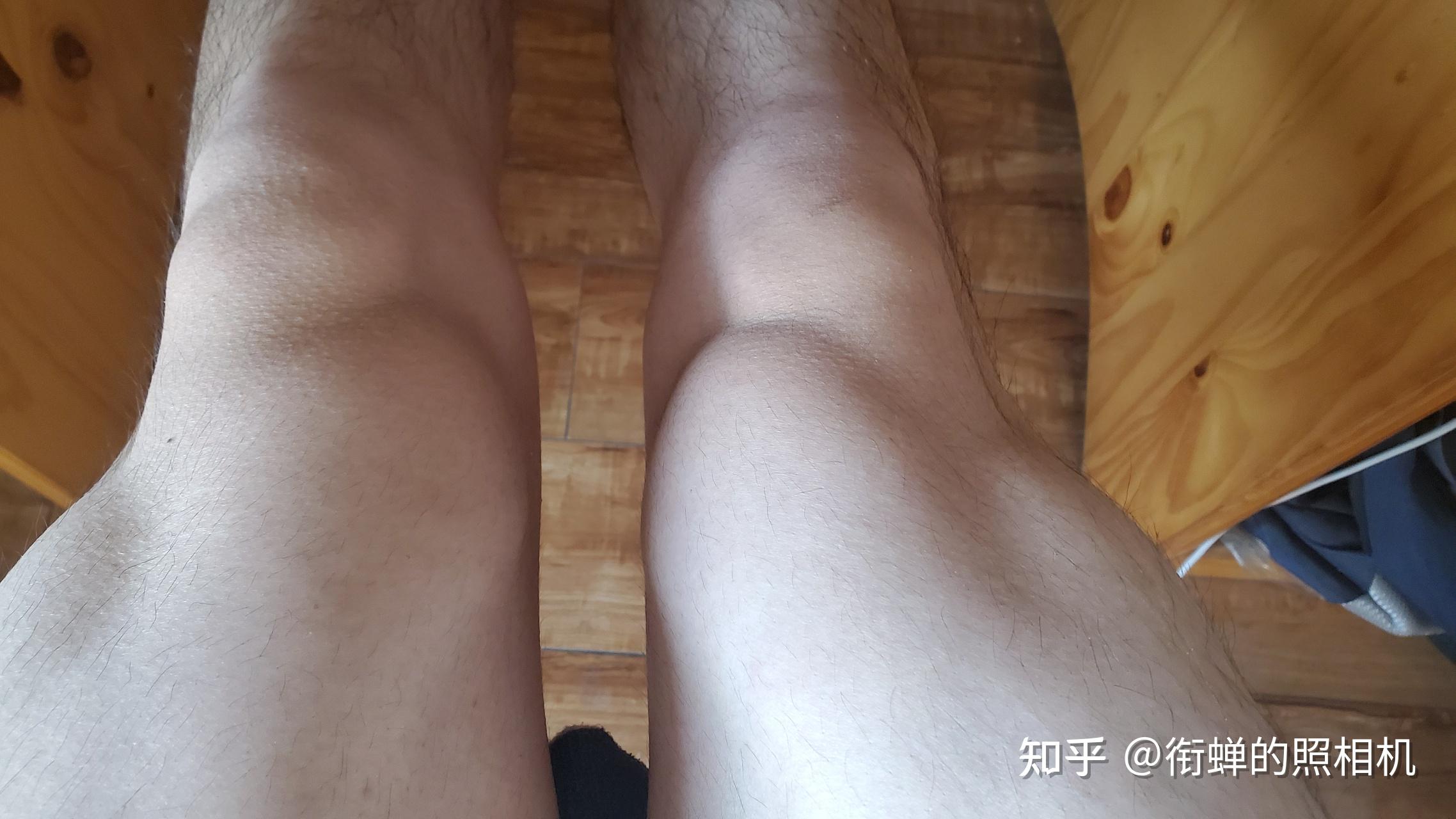 膝盖斜上方靠近大腿内侧肌肉突出怎么办