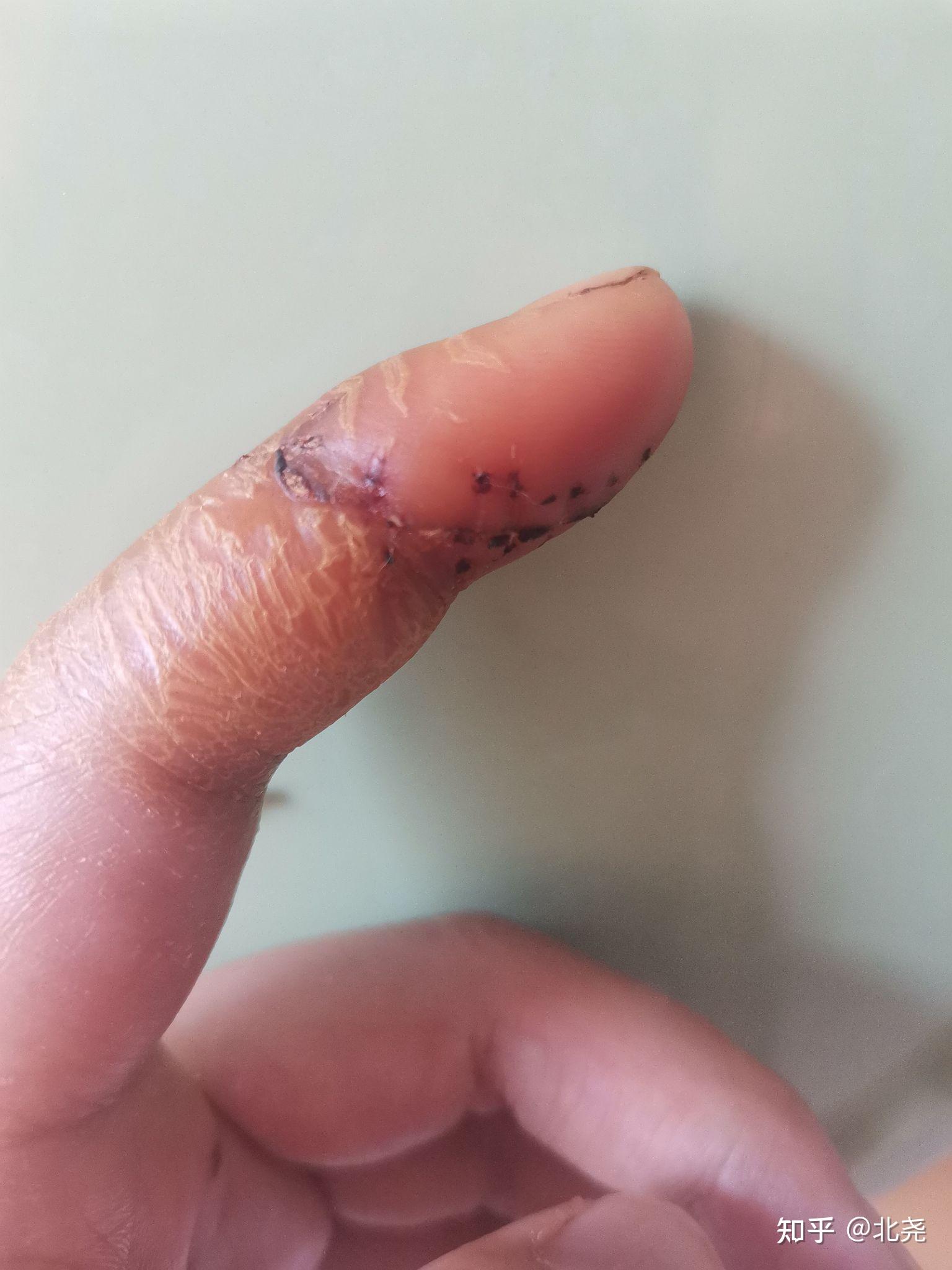 手指肌腱神经断裂需要多久恢复?术后9天手指还肿正常吗? - 知乎