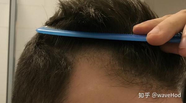 微针生发案例9滚针2米诺地尔4个月前额头发再生