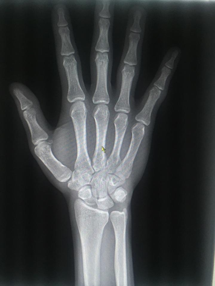 看下骨骼线闭合没有?