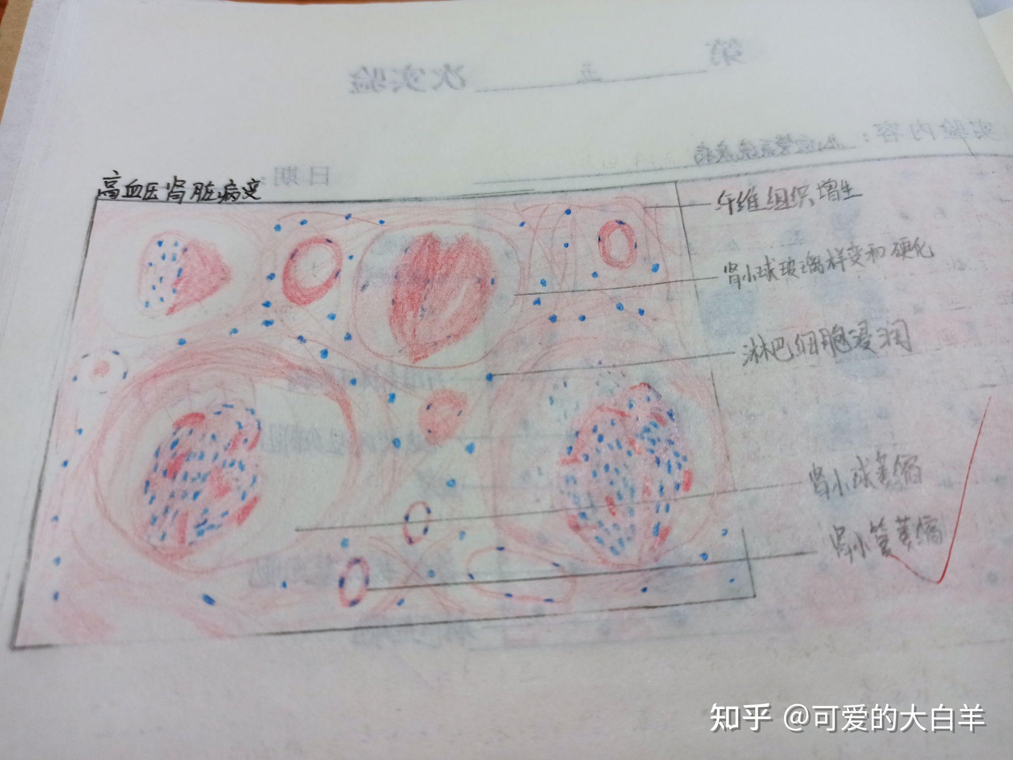 肾透明细胞癌红蓝铅笔图片