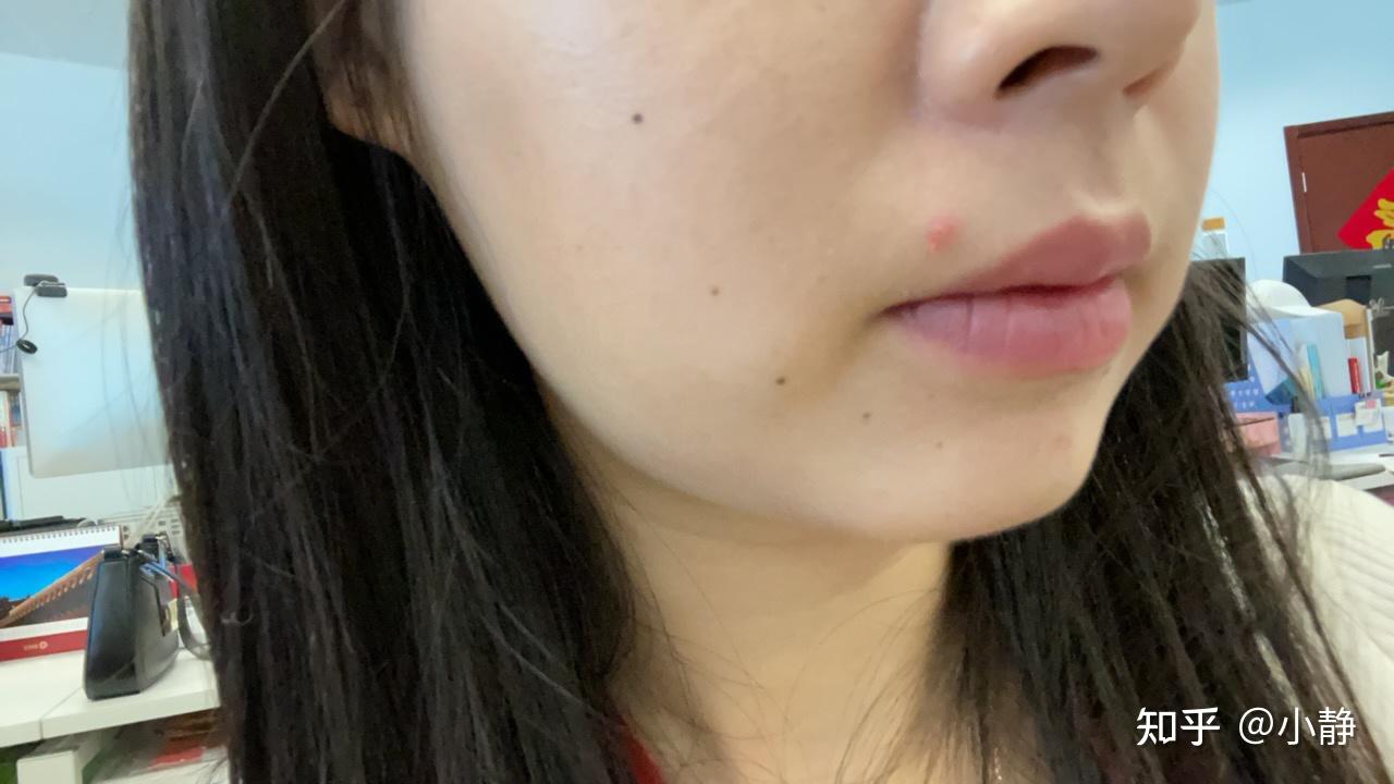 我的第一次点痣记录