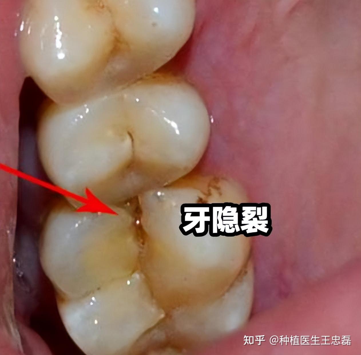 牙齿出现这种裂纹正常吗?专家告诉你什么情况才要去看医生 - 知乎