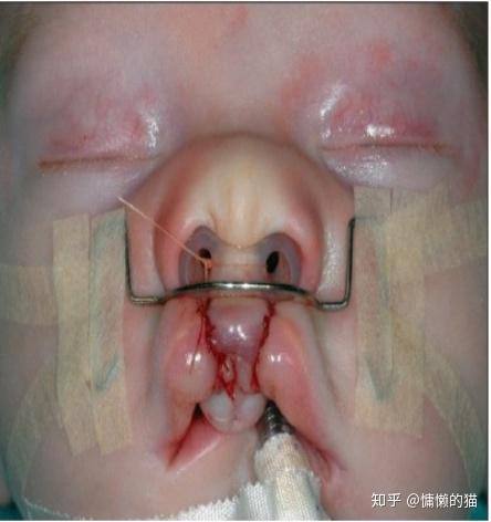 有唇腭裂的baby术后也会使用特殊的喂食器说了好多来看解析吧a 腭裂