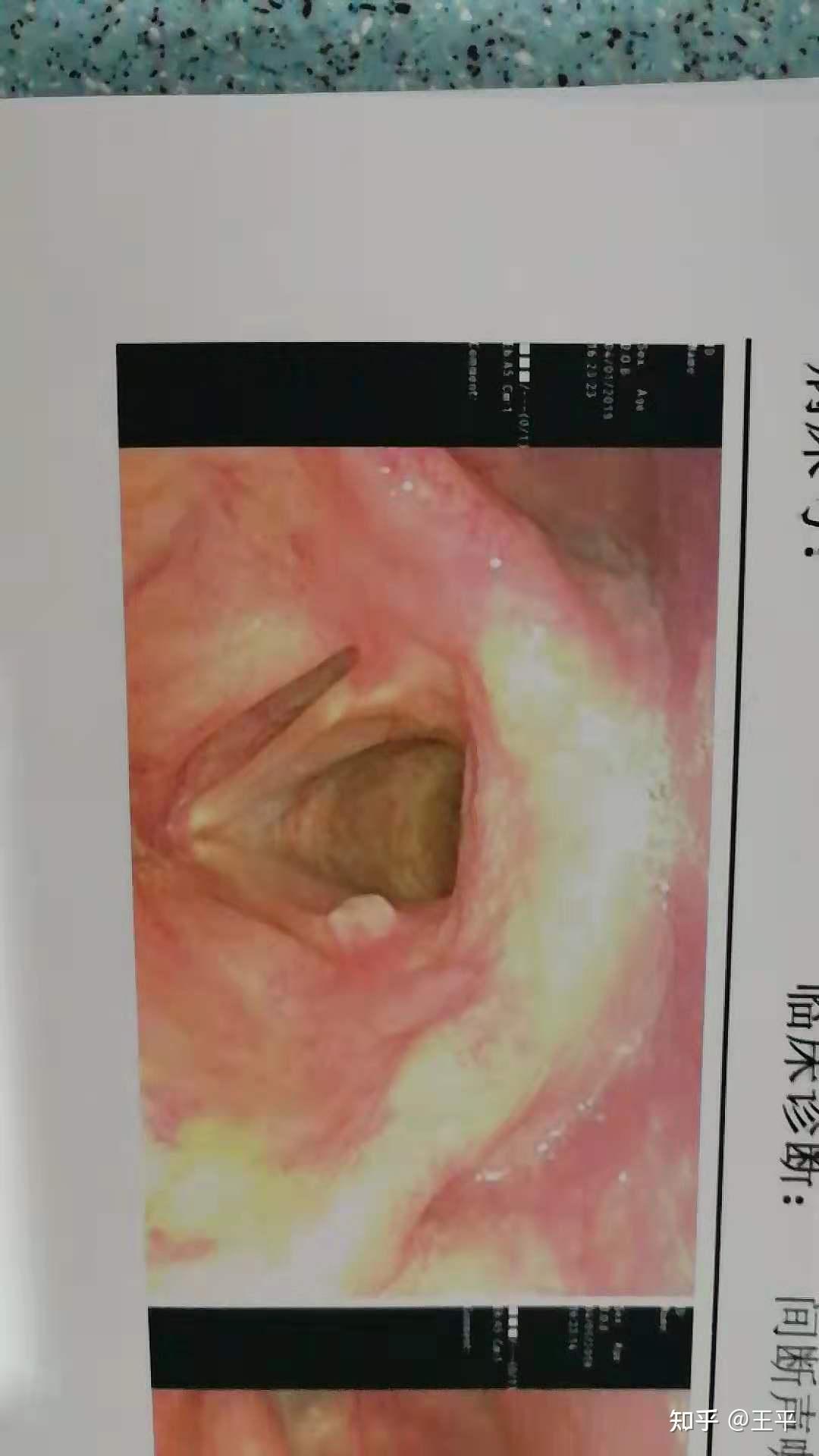 胃食管反流的零元治疗