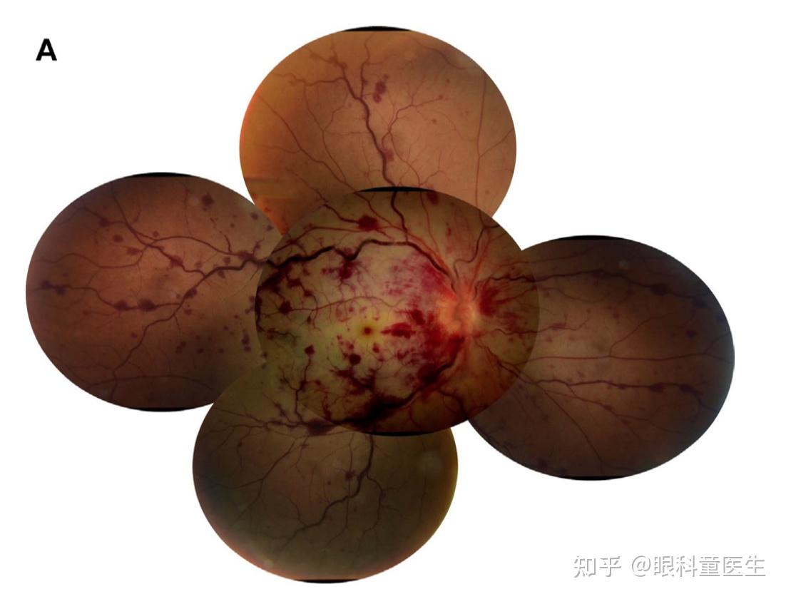 视网膜血管性疾病——1,视网膜静脉阻塞