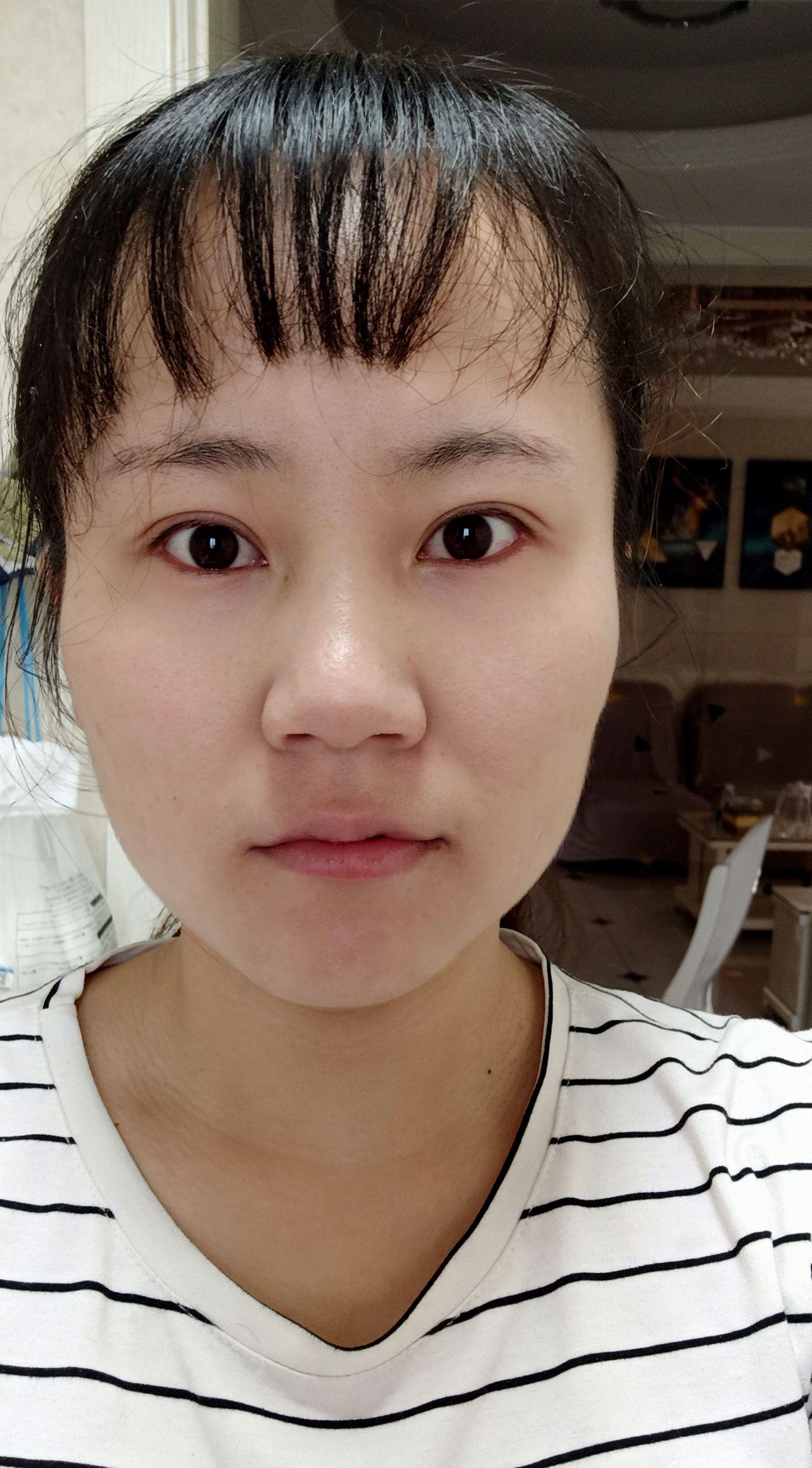 戴了十年框架眼镜,呆呆的死鱼眼有救吗.