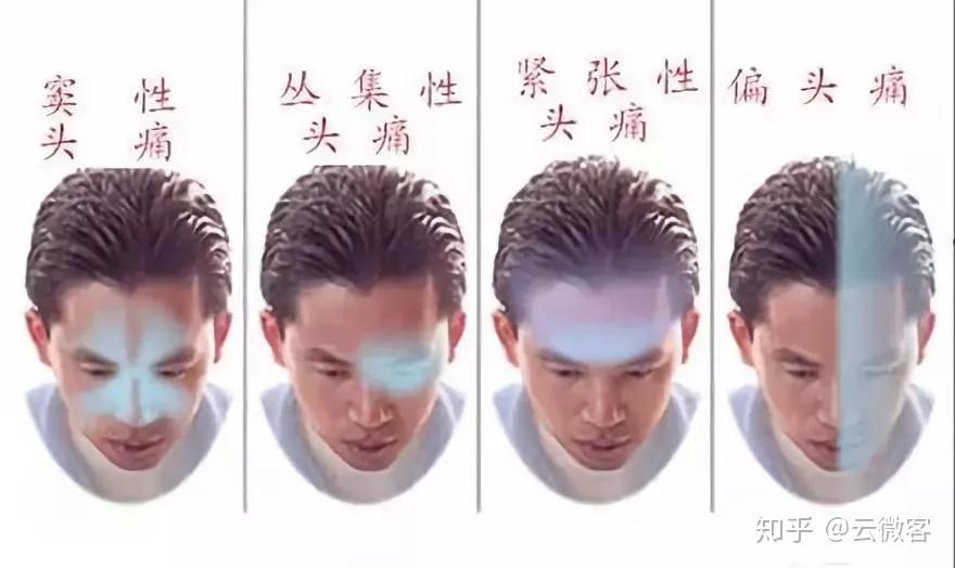 偏头痛的松弛之肌——颞肌 - 知乎