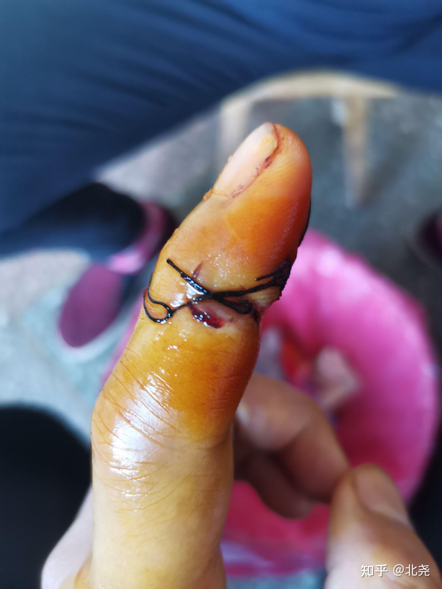 手指肌腱神经断裂需要多久恢复?术后9天手指还肿正常吗? - 知乎