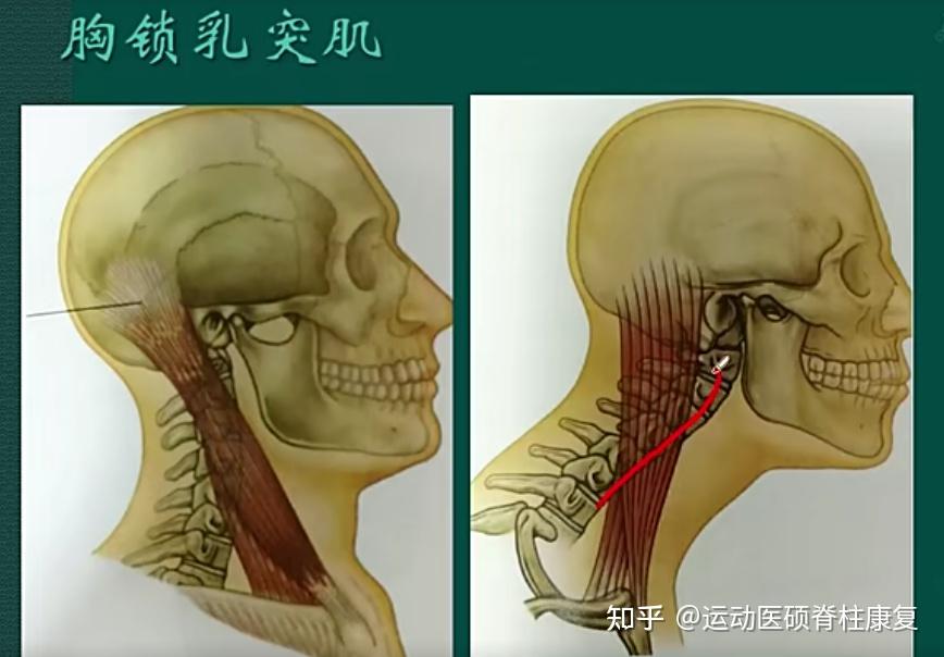 胸锁乳突肌痉挛图片