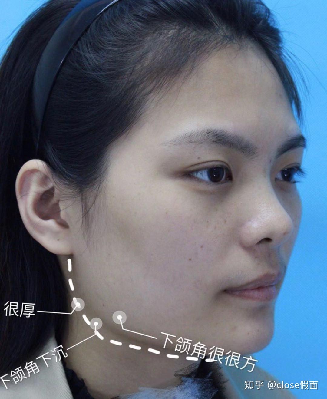 磨骨应该如何规避风险
