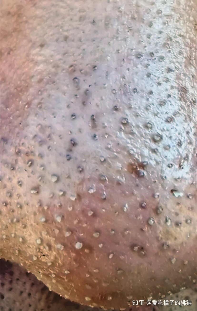 黑头严重怎么办啊?