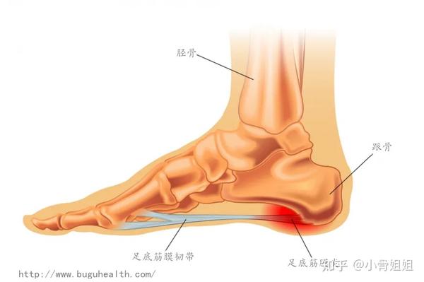 布骨医学科普 足底筋膜炎是导致足跟痛的最常见的原因 一篇科普了解它 知乎