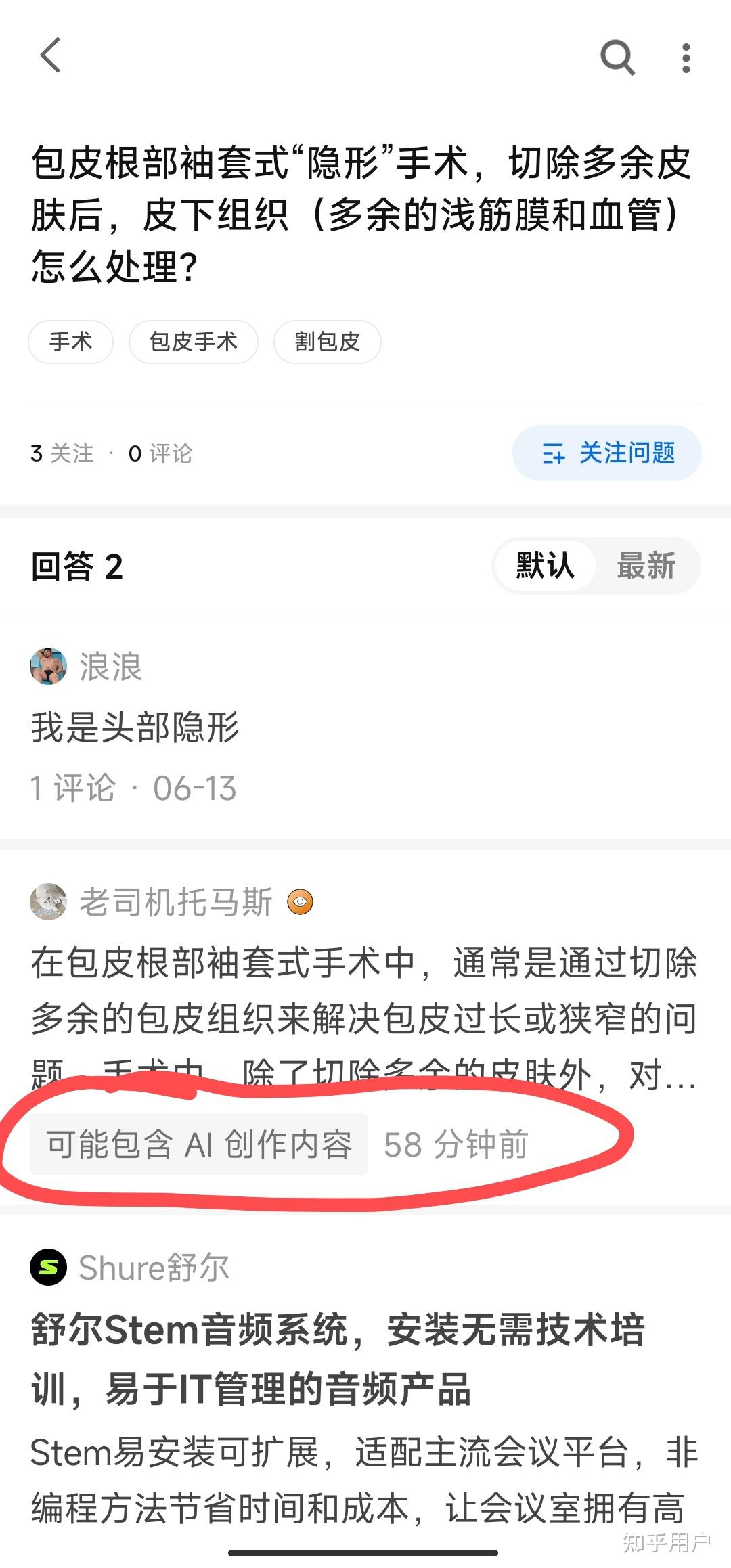 包皮根部袖套式"隐形"手术,切除多余皮肤后,皮下组织(多余的浅筋膜和
