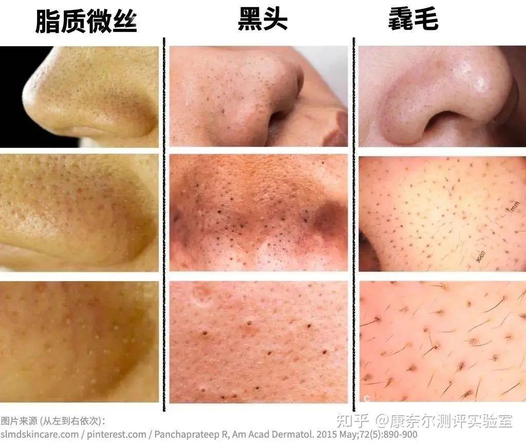 这是毳毛还是黑头?求求解答,有什么方法去除吗? - 知乎