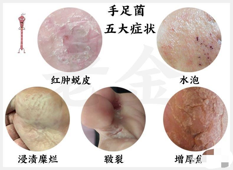 你是如何治好自己足癣的?