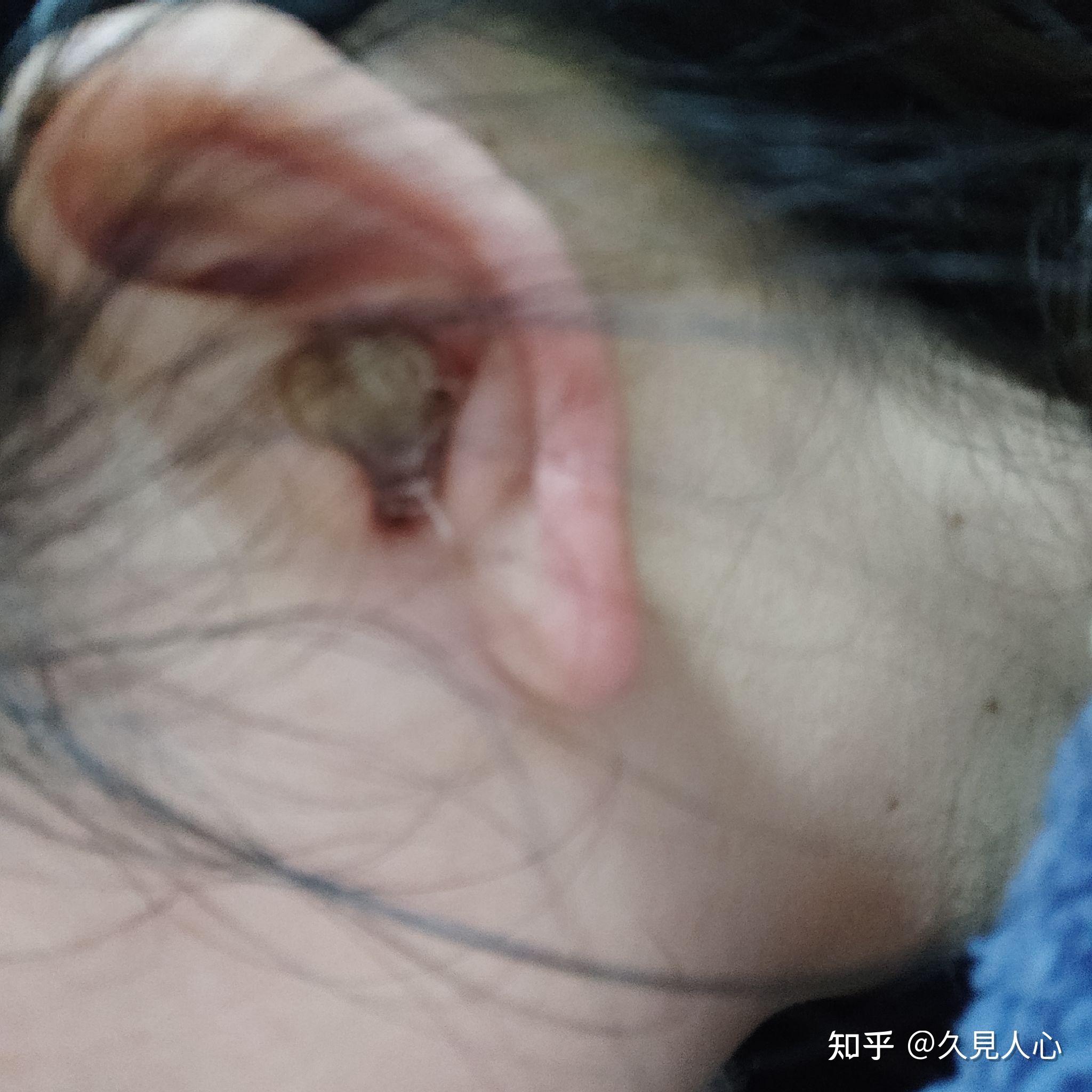 外耳道发现肿物,还好不是胆脂瘤,手术清理过程记录? - 知乎
