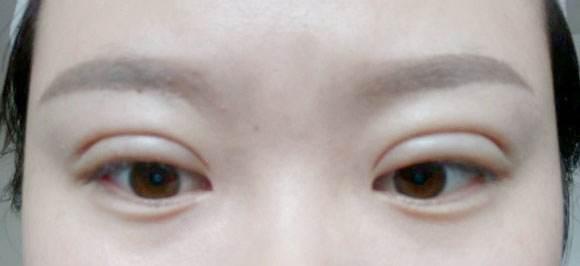 双眼皮术后有肉条感怎么办能修复吗