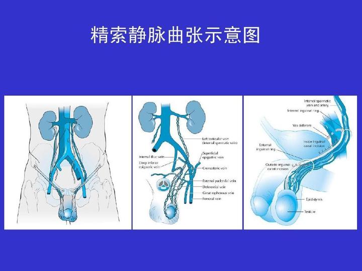 于文晓医生:哪类人群容易得“精索静脉曲张”? - 知乎