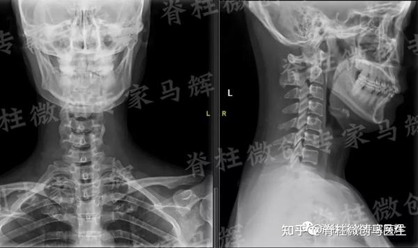 神经根受压上肢麻痛剧烈 脊柱内镜微创治疗不开刀 知乎