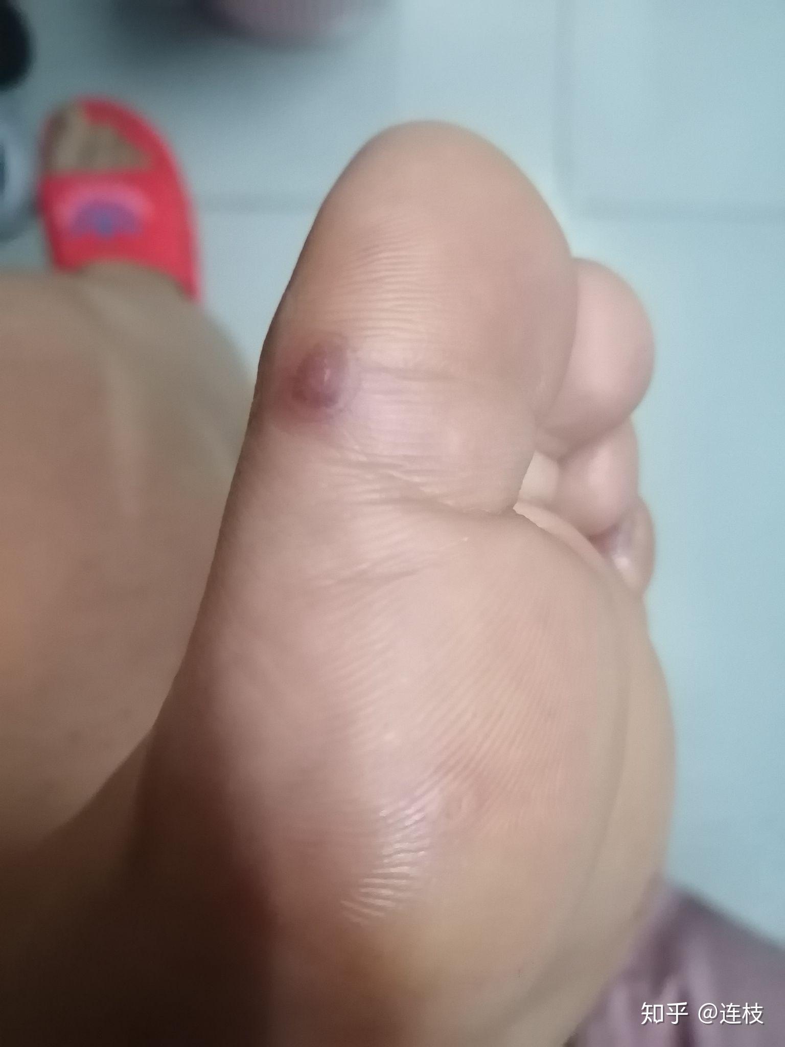 脚上感染长了疣怎么弄