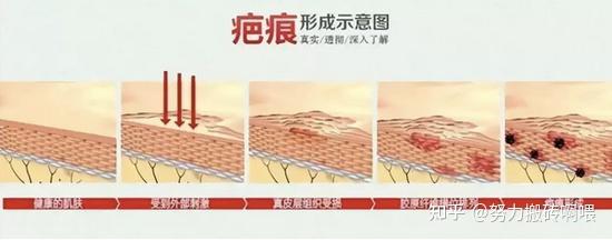 你真的是“疤痕体质”吗? - 知乎