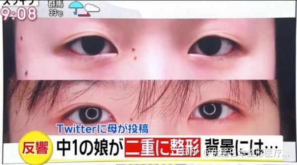 日本主妇瞒着丈夫 偷偷带未成年女儿割双眼皮 引10万人点赞 日本医美 知乎