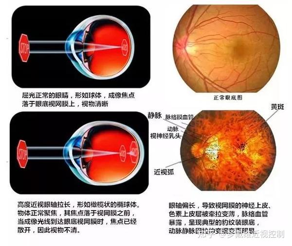 近视原因是什么,近视原因是什么引起的