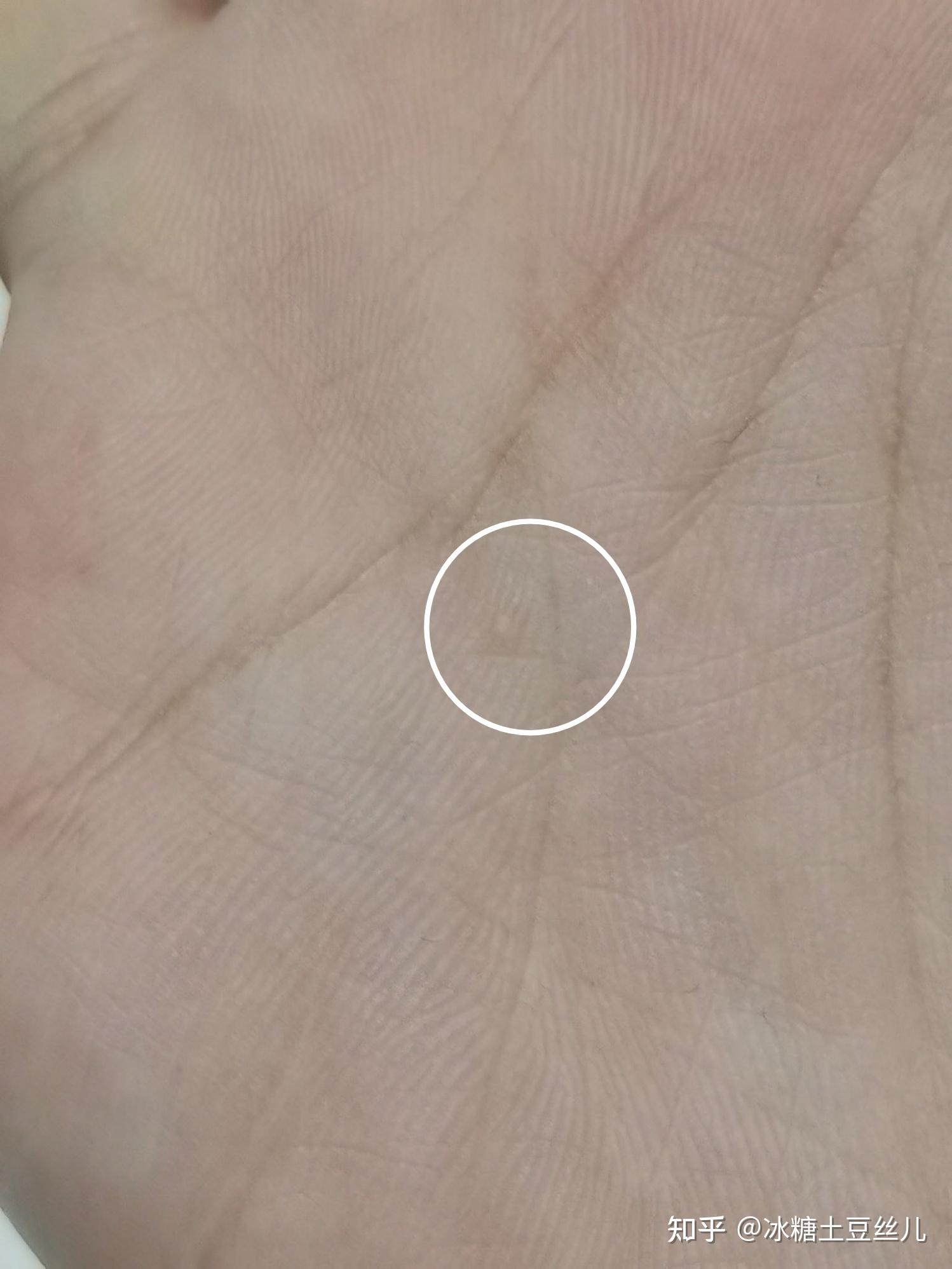 手掌心中间像是一个茧子困扰了好几年该怎么解决呢
