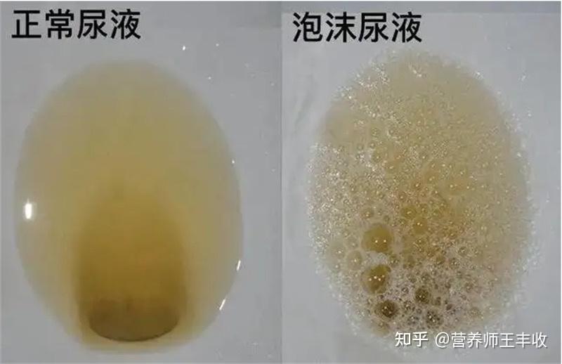 小便有泡沫,但多喝水就没有了,这是怎么了? - 知乎