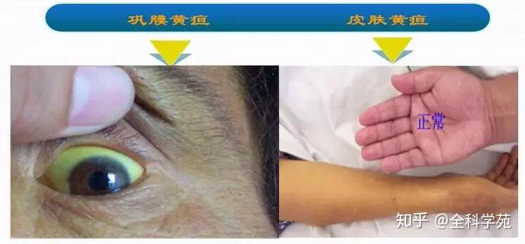 从症状谈疾病系列黄疸