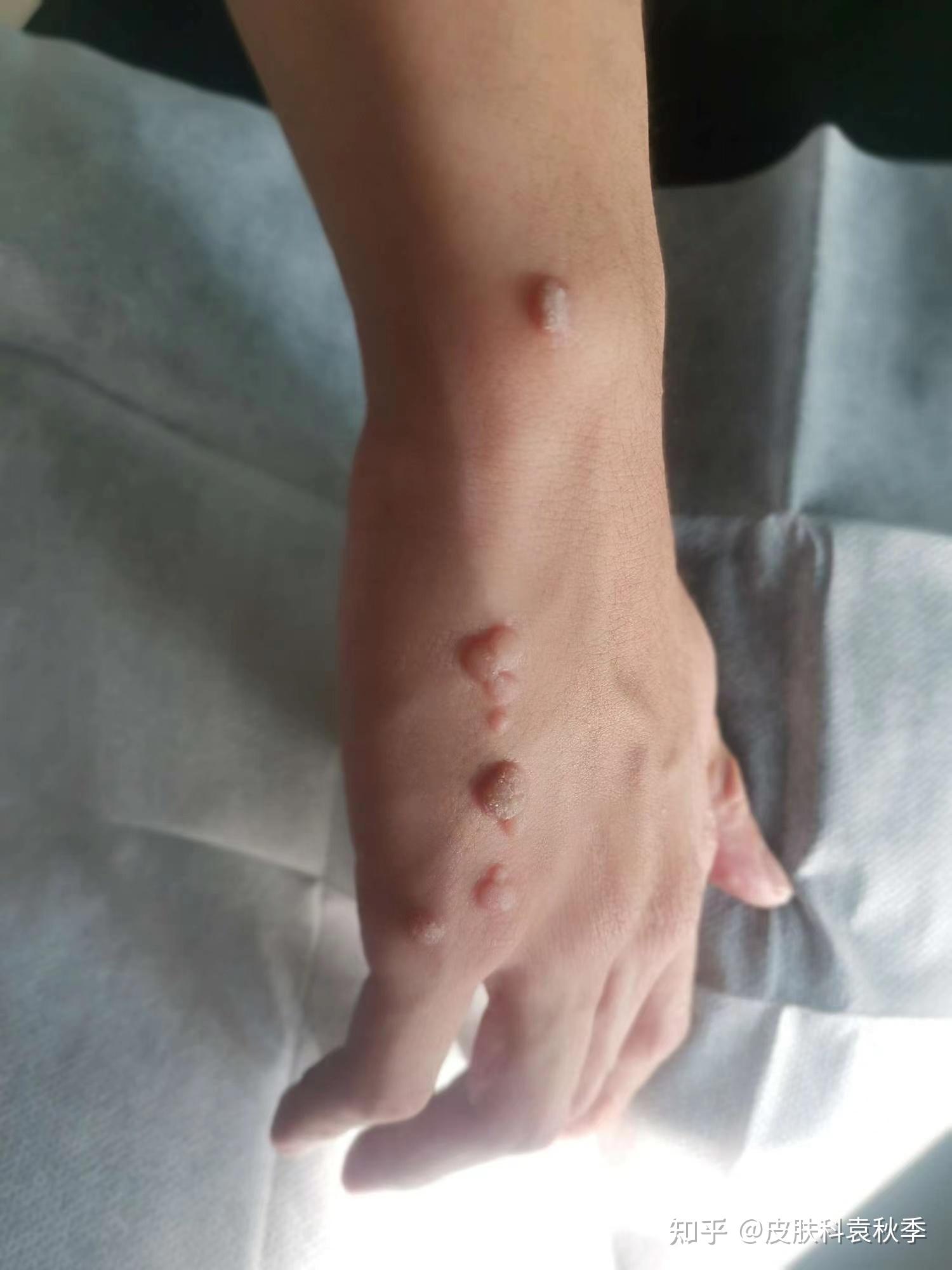 感染hpv皮肤有什么症状图片