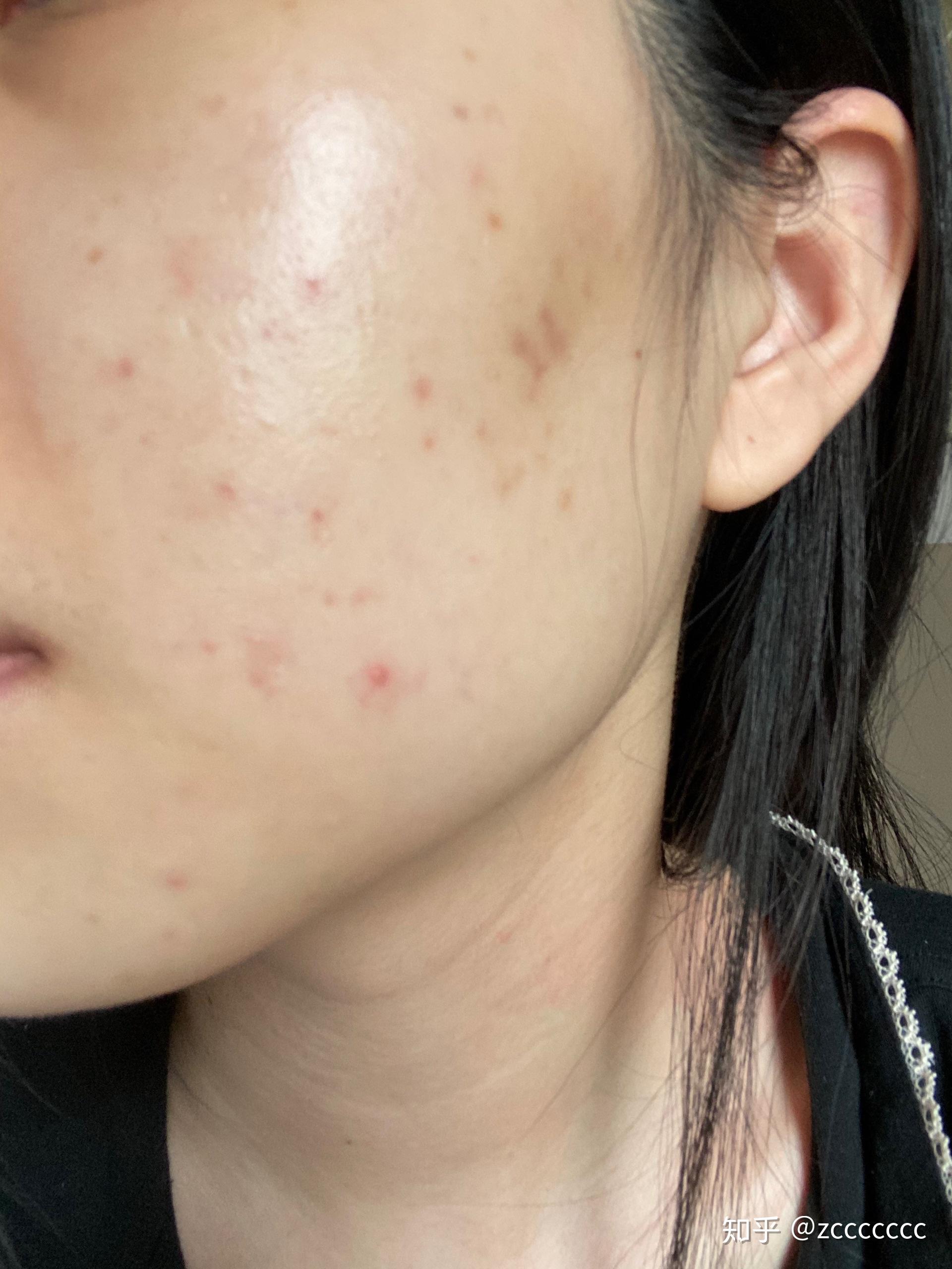 维a酸乳膏使用日记