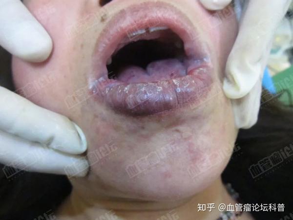 【董医生科普】血管瘤新旧名称对照