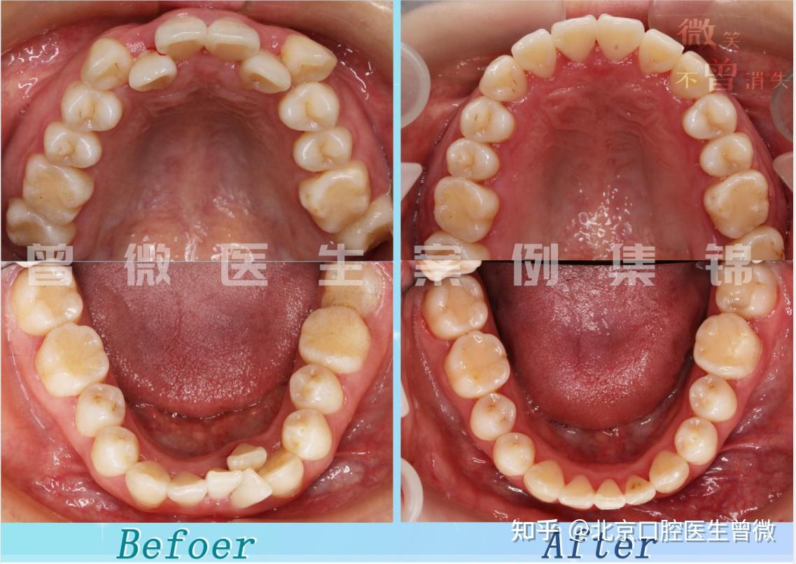 案例总结:正畸结束后,牙齿排列整齐,咬合关系正确,牙弓弧度优美,侧貌