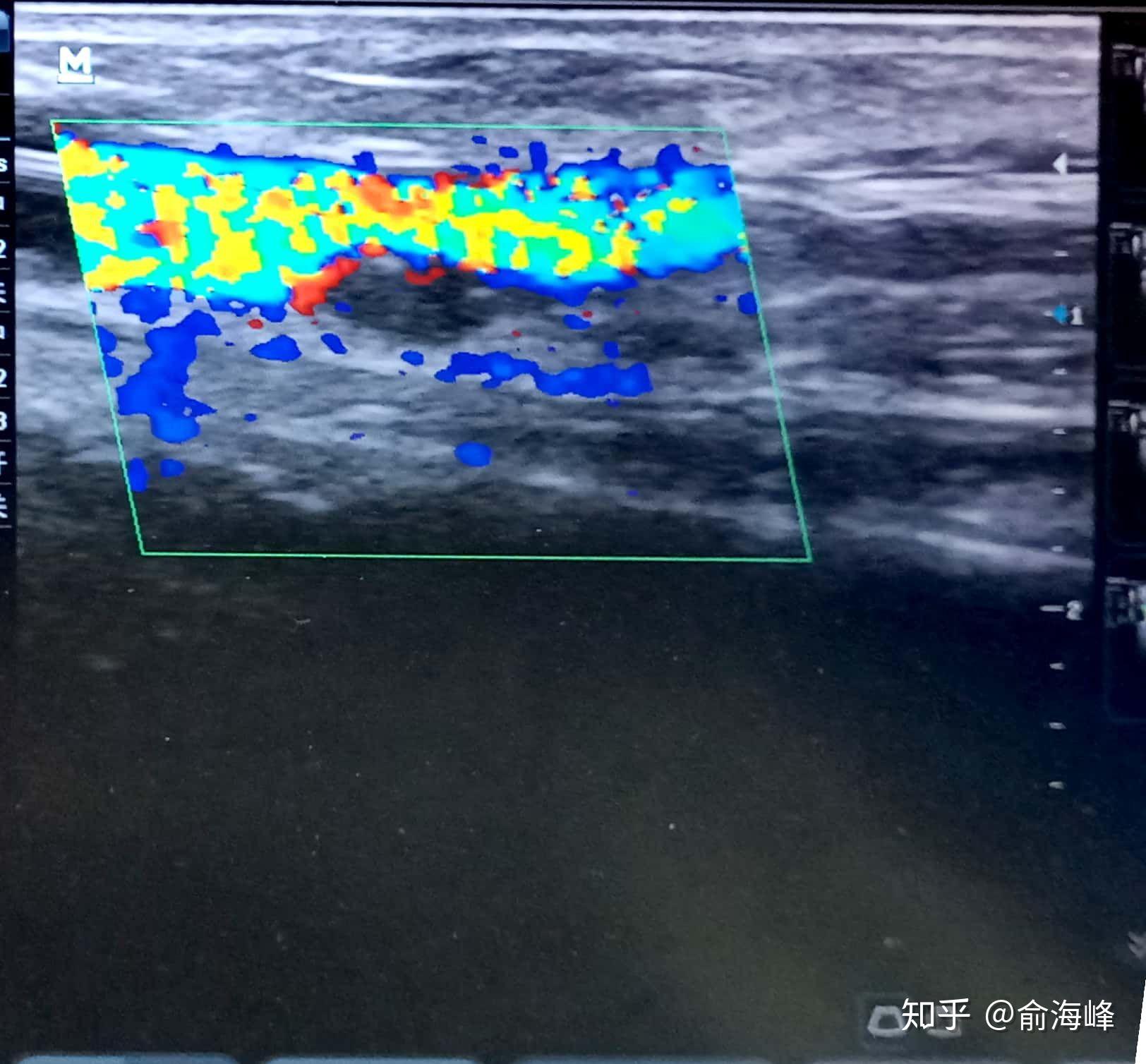 球囊先擴張流出道近心端第狹窄s2,然後擴s1,在擴s1的時候球囊覆蓋假性