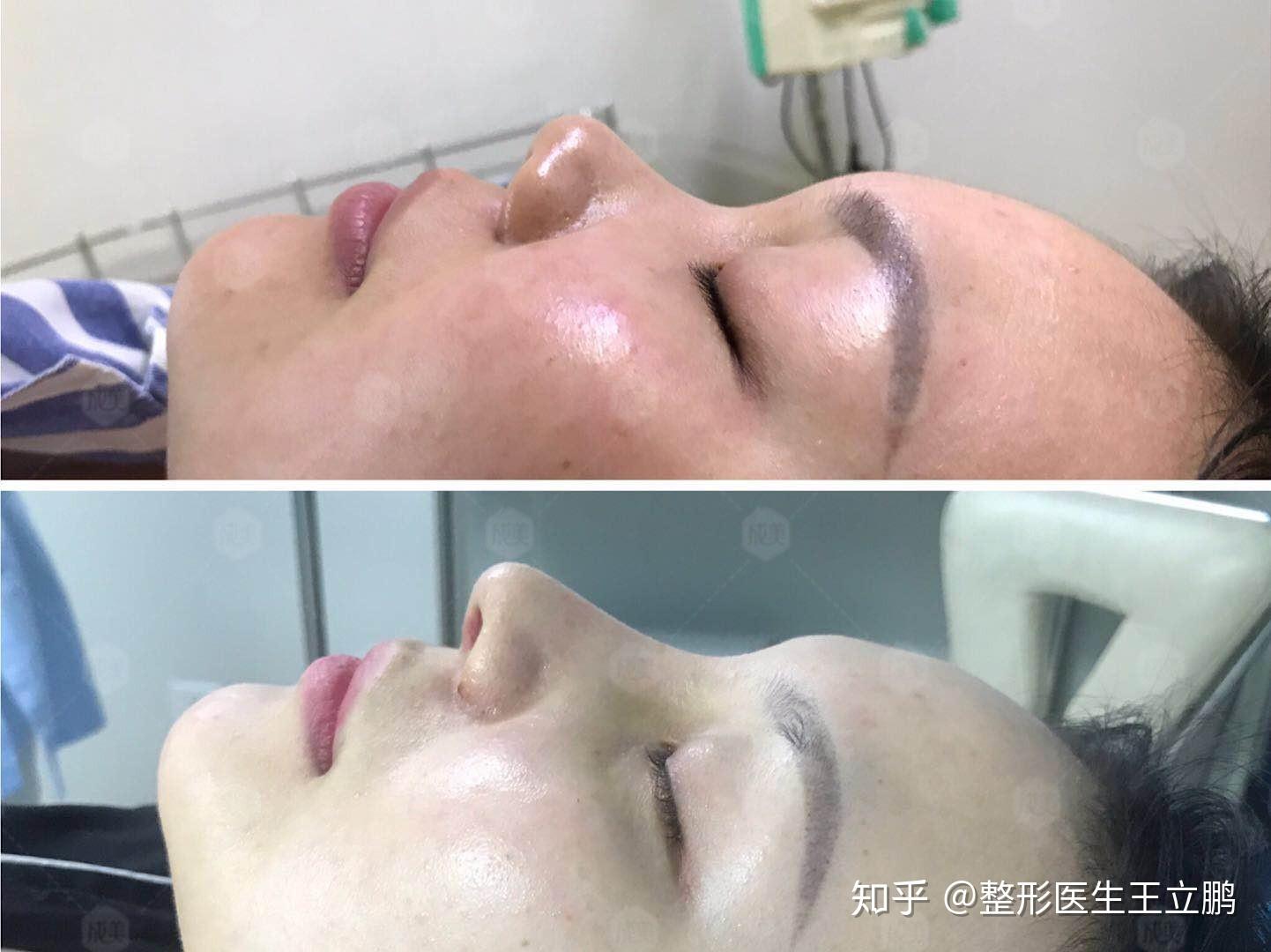 鼻中隔较短方案设计一,手术方案规划和说明:用假体垫高鼻背,取耳软骨