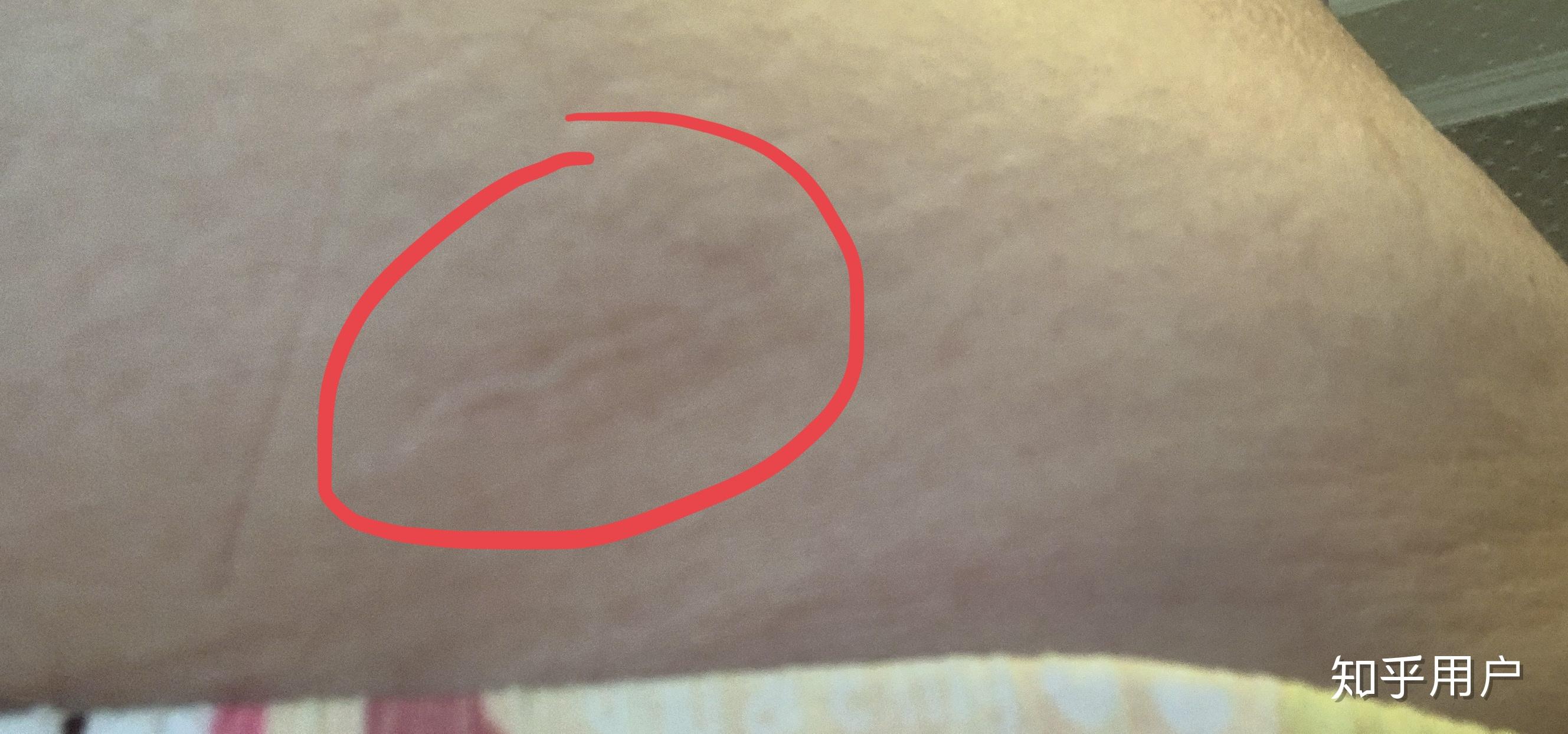 女朋友肚子左右两边和肚脐眼有手术刀口请问是做过什么手术