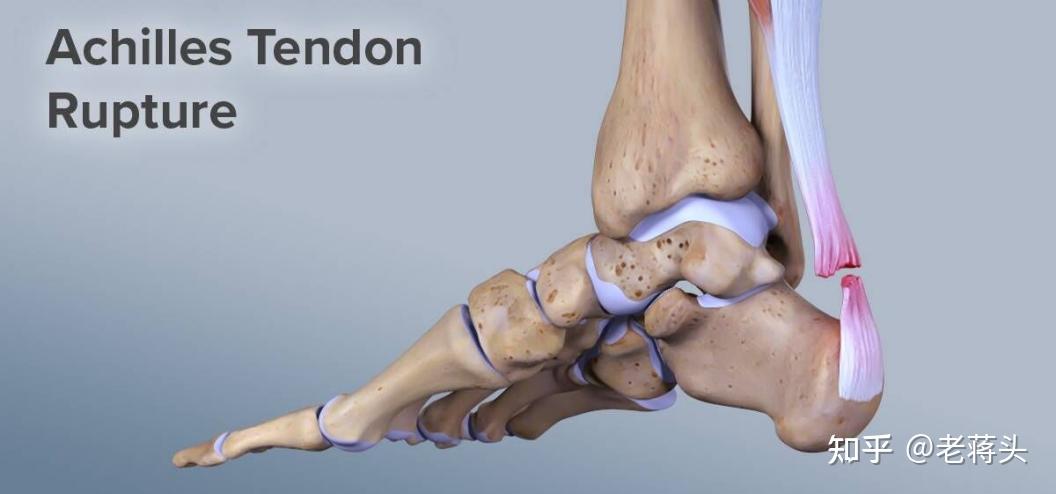 "阿基里斯腱"之痛——跟腱炎