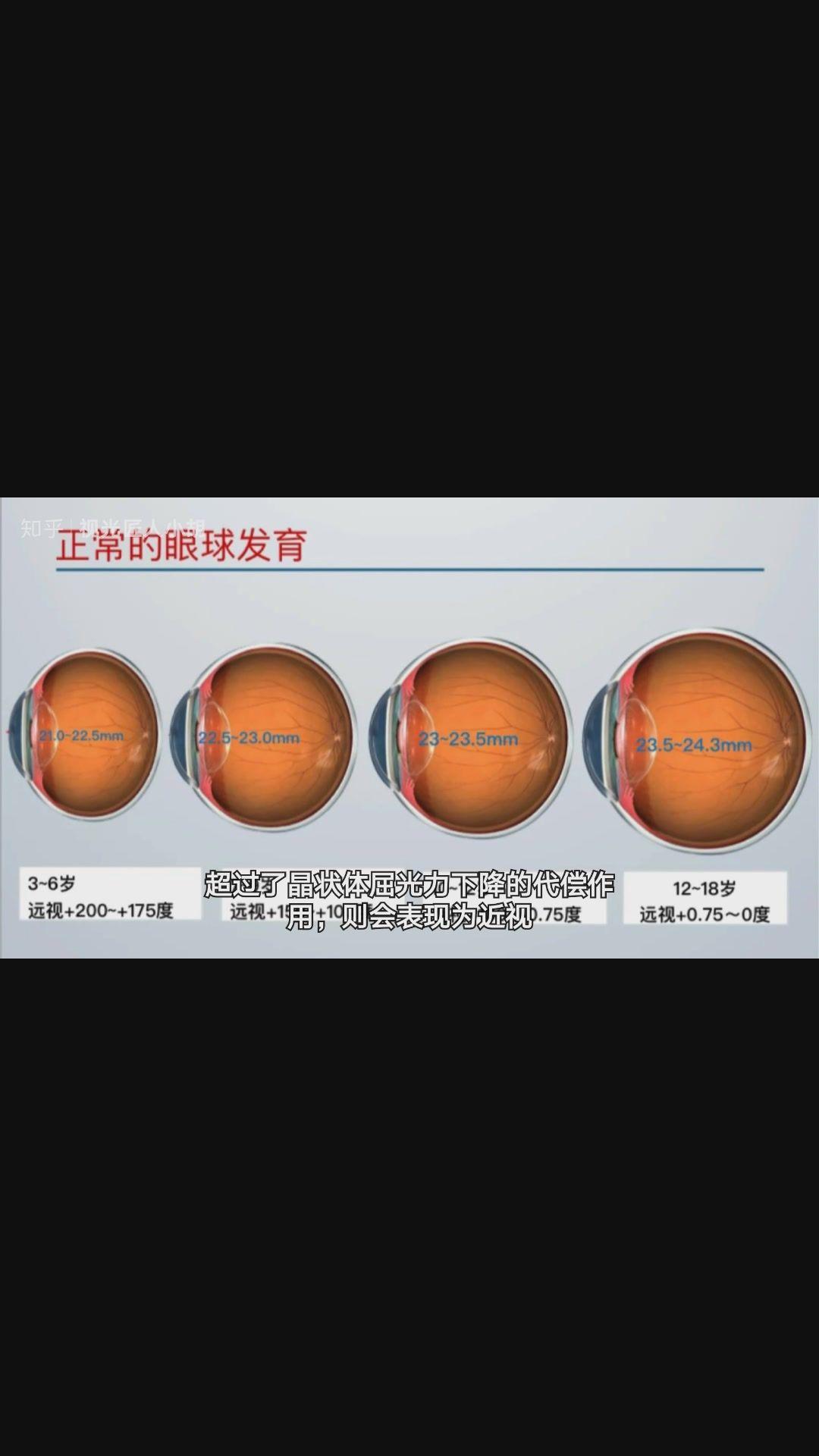 眼轴是怎么变长的?