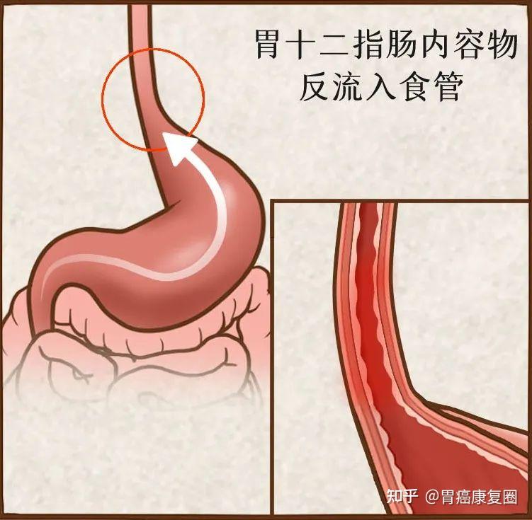 经常反酸烧心？胃癌患者常见并发症，教你有效应对！ - 知乎