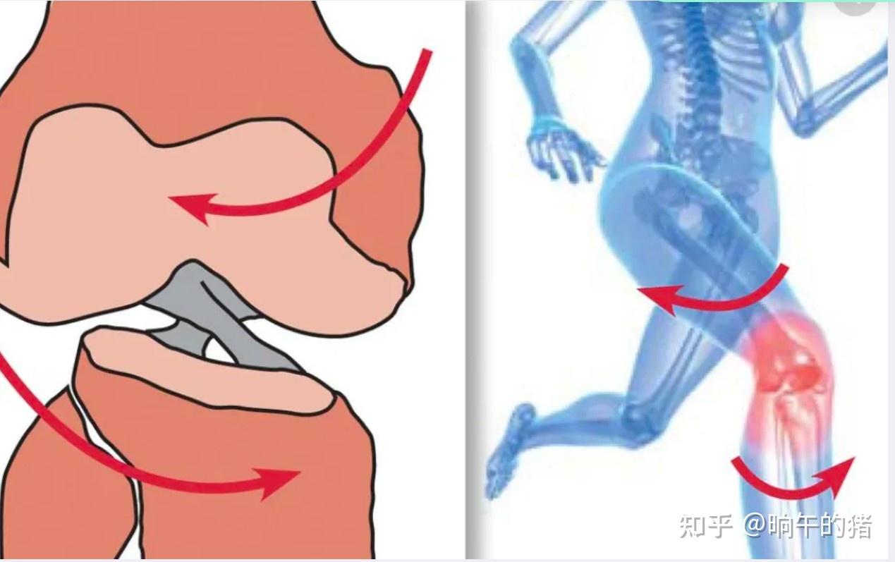 作为物理治疗师,你要知道的前交叉韧带(ACL)损伤急性期与术前准备期要点(附康复动作参考) - 知乎