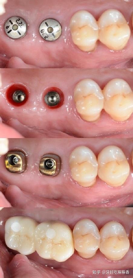 我为什么选择种植牙