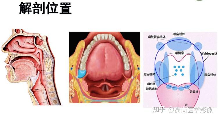 咽侧索增生图片